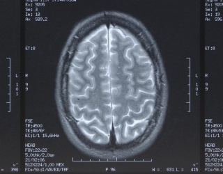 Catalyst MedTech Expands Brain PET Implementation in the U.S.