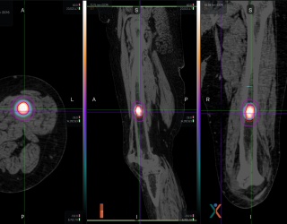 Modern Radiotherapy Approaches in Head & Neck Cancer