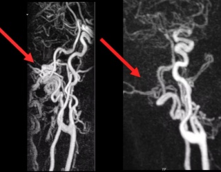 Neuroradiology Enables Targeted Treatment for Pulse-Synchronous Tinnitus