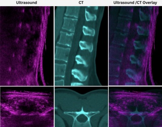 Photo: Real-Time Panoramic Ultrasound Approach Expands Spine Imaging Options...
