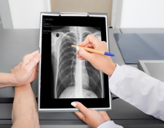 Photo: AI Chest X-Ray Analysis Helps Detect Hidden Lung Cancer Risks...