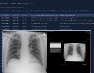 Photo: AI Tool Accelerates Lung Cancer Detection Across North East London...