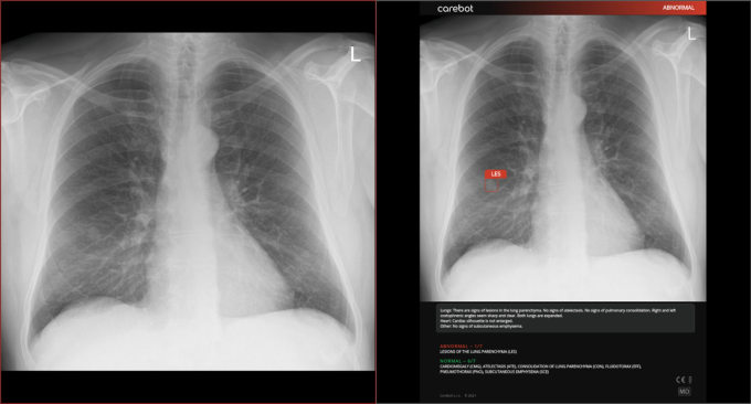 An x-ray image of a chest