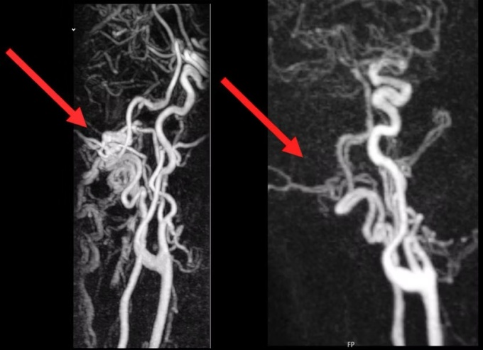 Two MRI scans placed side by side. The left scan shows the MRI before...