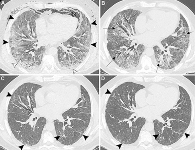 Four lung CT scans labeled A–D, demonstrating residual lung abnormalities...