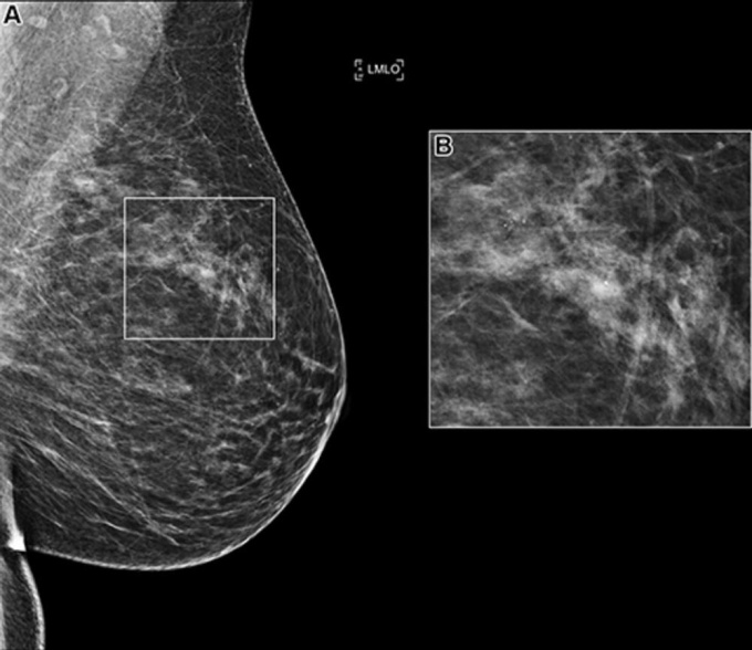Mammogram with highlighted microcalcification