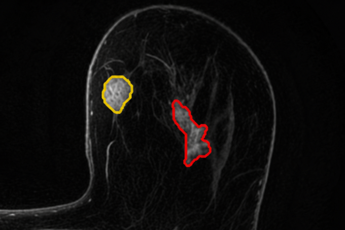 MRI breast scan