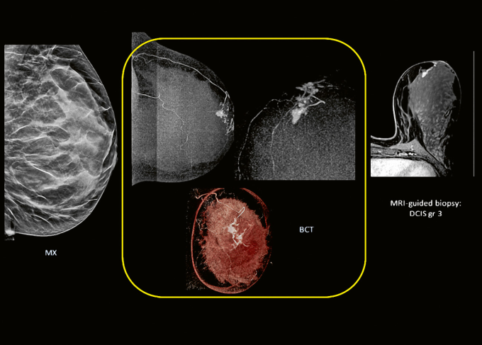 This is the image of breast-CT of DCIS on breast CT (middle, in the yellow box)...